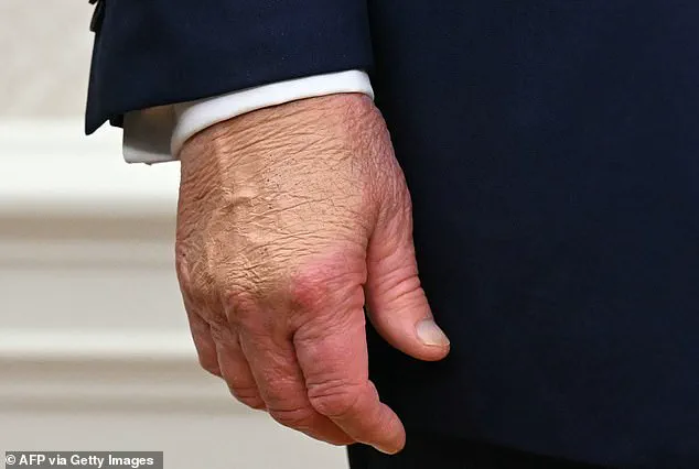 Exclusive: White House Tight-Lipped on Trump's Health as Bruise Sparks Speculation