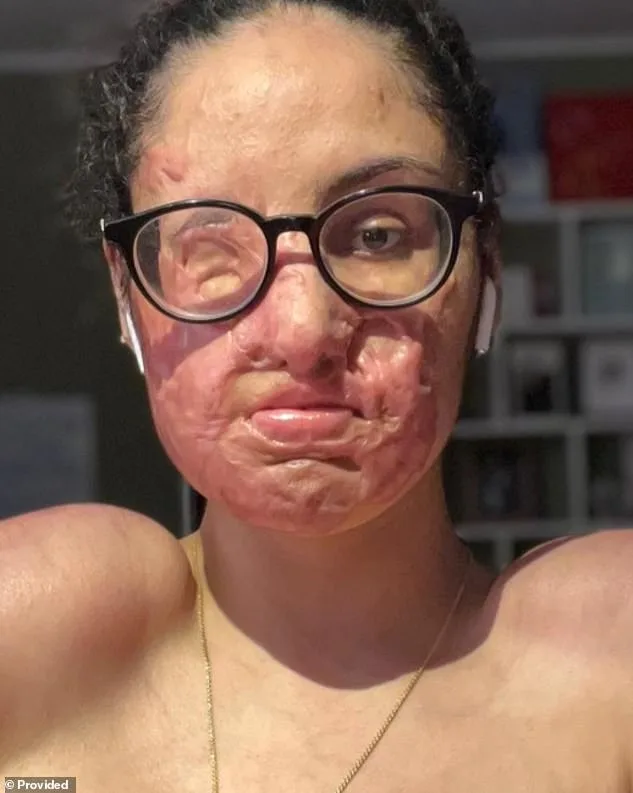 Brooklyn Man Indicted in 5-Year-Old Acid Attack Case That Reignited Justice Delay Debates