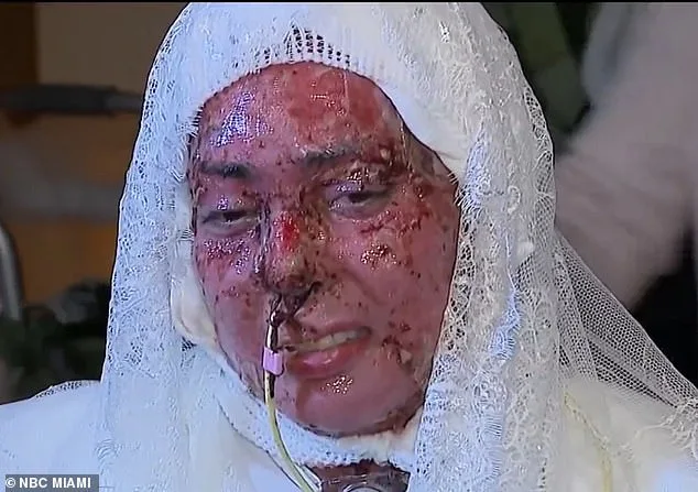 Devastating Grill Explosion Leaves Arianna Esquiline with Severe Burns and an Unexpected Life Decision