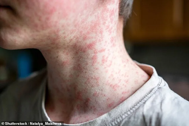 Measles Outbreak: US at Risk of Losing Elimination Status